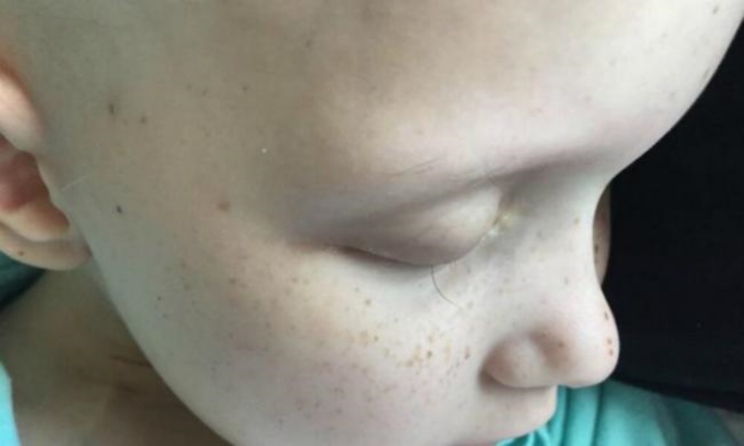 A menina com um único cílio: australiana de sete anos tocou corações em todo o mundo