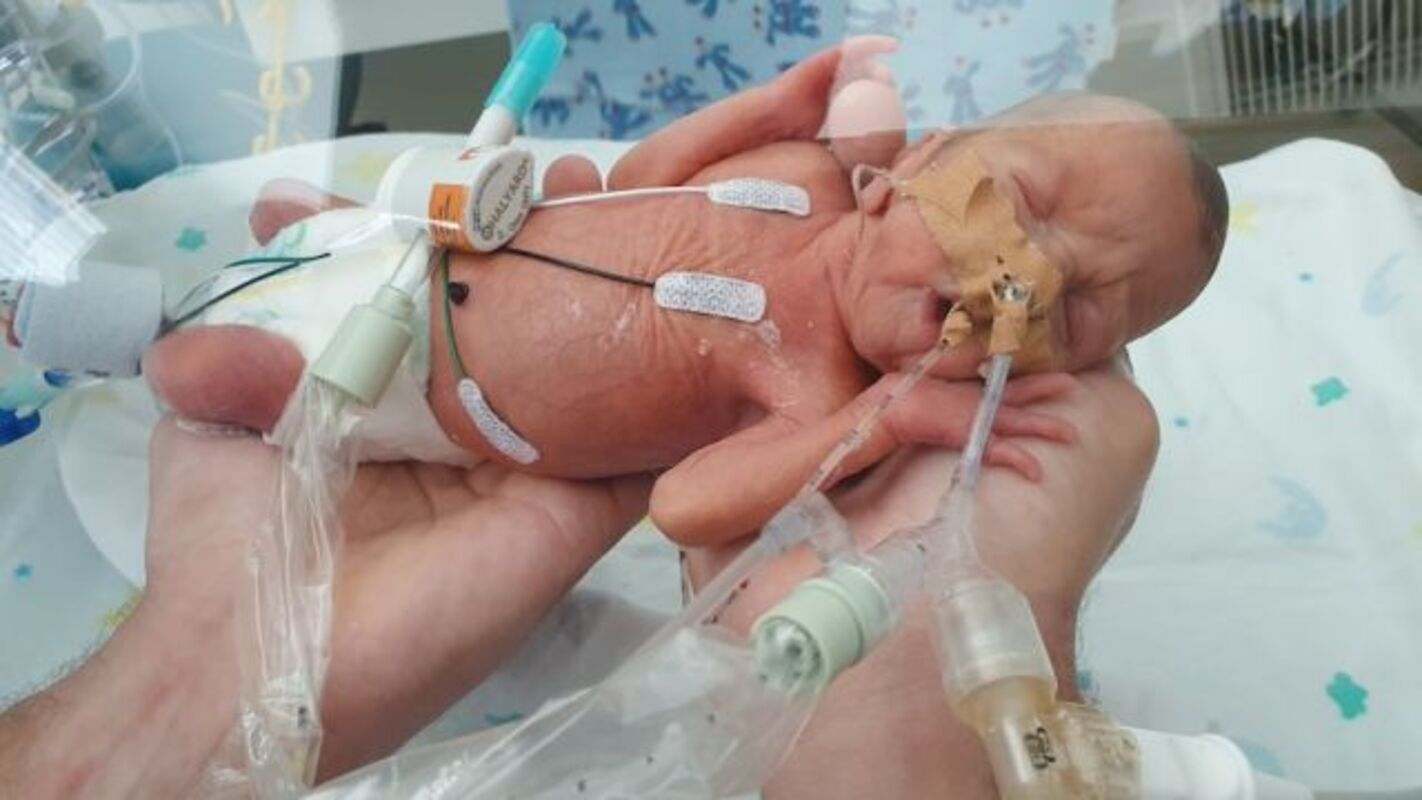 Bebê prematuro que deveria nascer com morte cerebral agora está dando seus primeiros passos