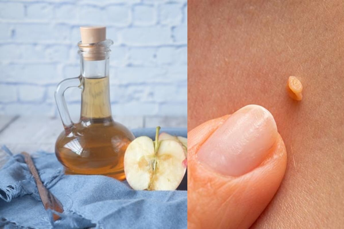 Aprenda a eliminar verrugas com vinagre de maçã, é muito simples